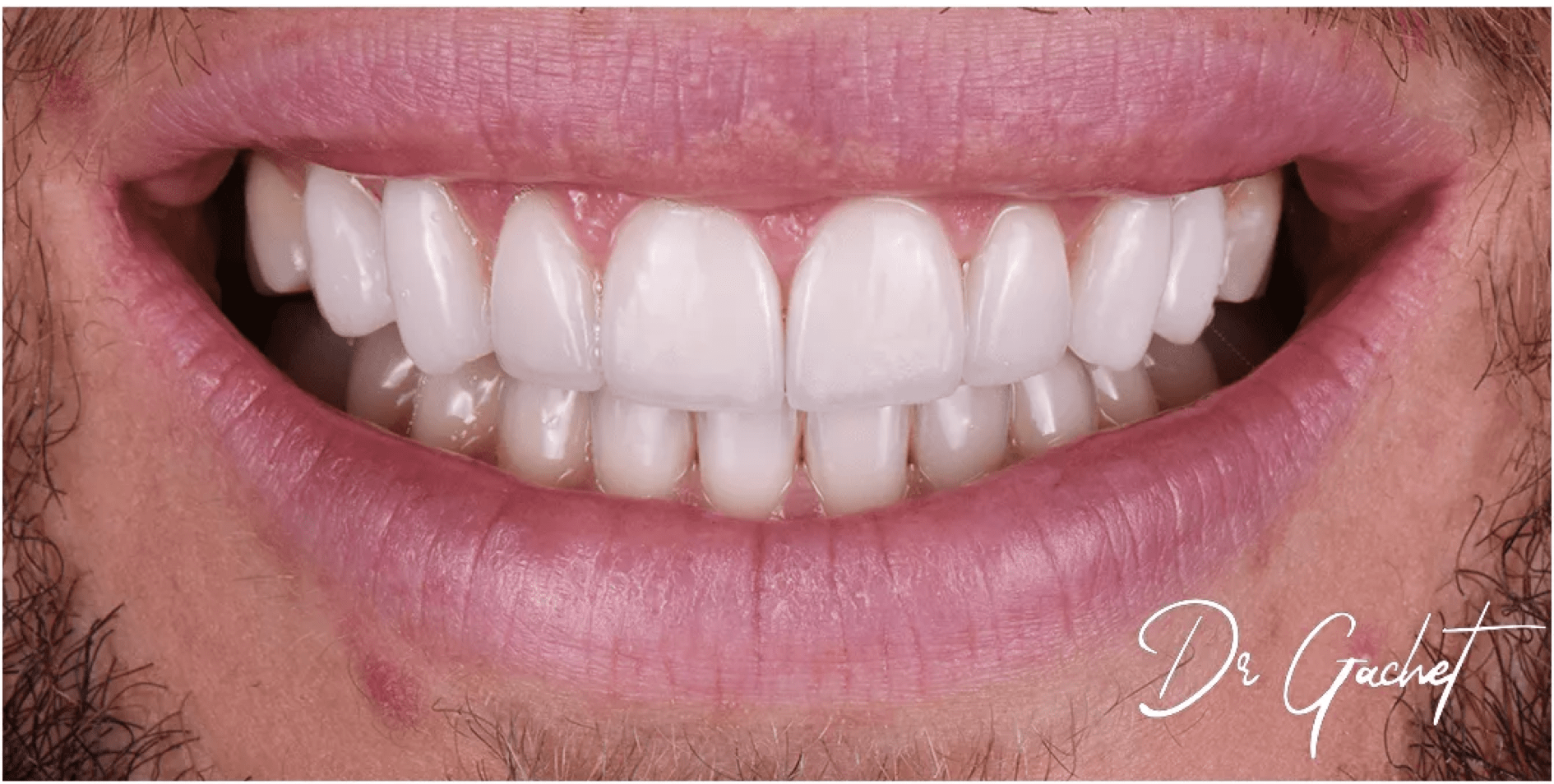 Rhone Dental Clinic Article Dental Veneers Q&a
