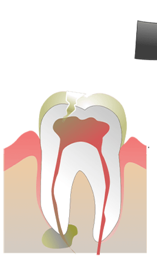 Rhone Dental Clinic Endodontie Etape Intervention 01 Dent Infectee
