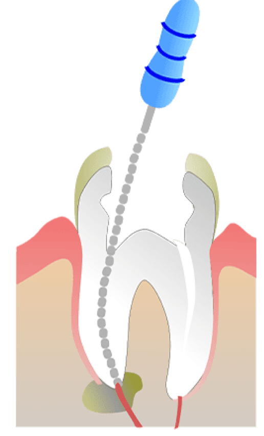 Rhone Dental Clinic Endodontie Etape Intervention 03 Enlevement Tissu Nettoyage Canal Traitement Laser
