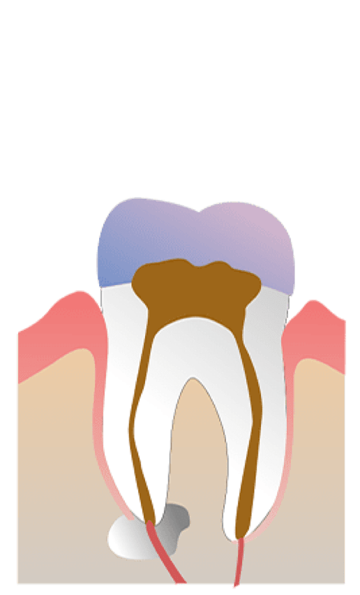 Rhone Dental Clinic Endodontie Etape Intervention 04 Ouverture Scellee Par Remplissage