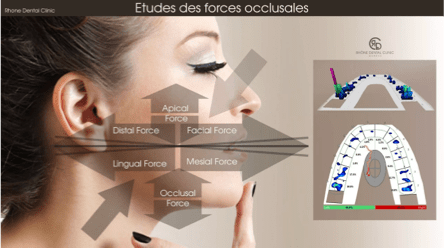 Rhone Dental Clinic Facettes Dentaires Maloclussion