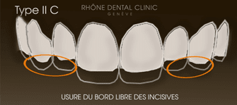 Rhone Dental Clinic Facettes Dentaires Type 2c