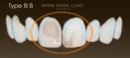 Rhone Dental Clinic Facettes Dentaires Type 3a
