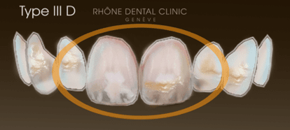 Rhone Dental Clinic Facettes Dentaires Type 3d