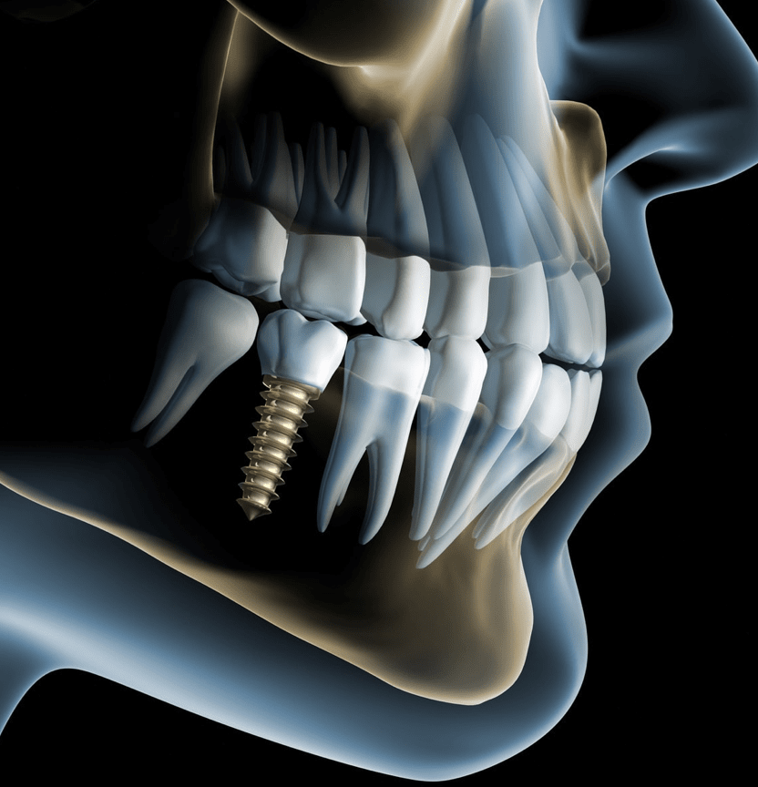 Rhone Dental Clinic Implants Dentaires Preparation Puit Implentaire