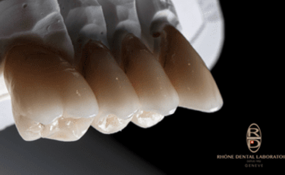 Rhone Dental Clinic Implants Dentaires Protocole Etape 03 Realisation Prothetique