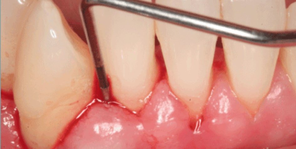 Rhone Dental Clinic Article Bleeding Gums Treatment Image01
