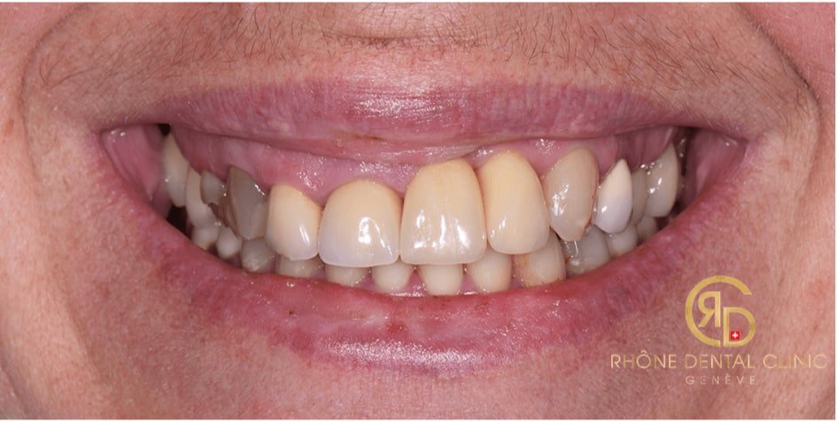 Rhone Dental Clinic Article Crooked Teeth Image01