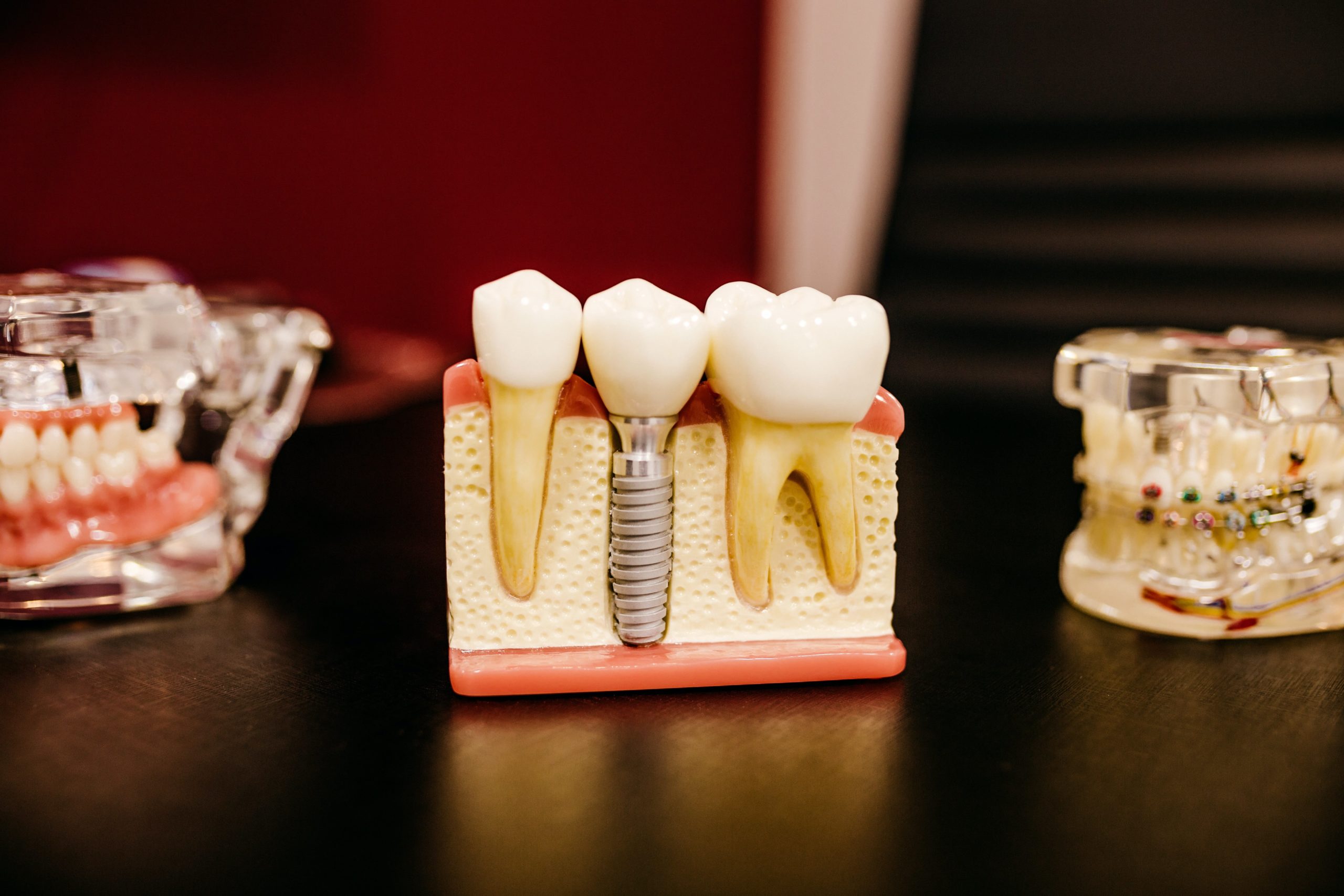 Rhone Dental Clinic Article Dental Prostheses Image01 4 Scaled