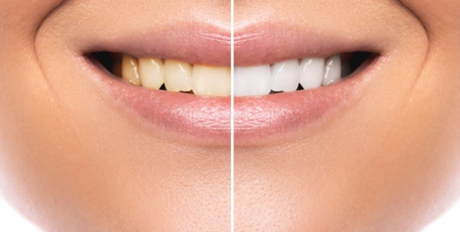 Rhone Dental Clinic Article Yellow Teeth Image01