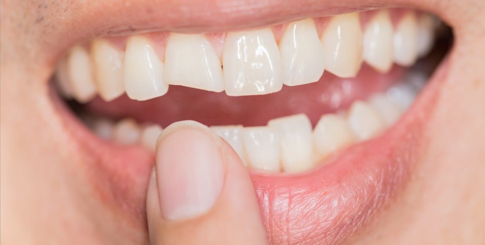 Rhone Dental Clinic Article Dent Cassée Image01