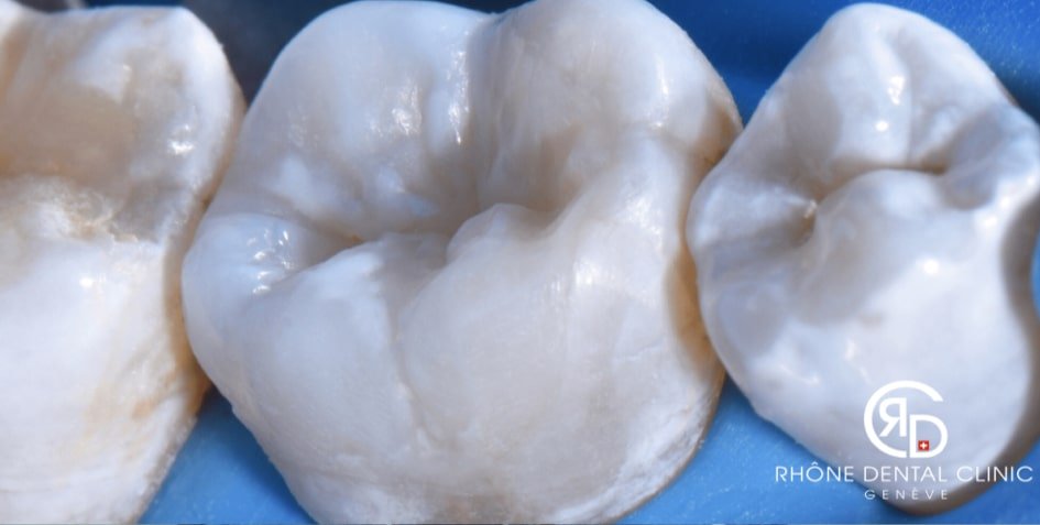 Rhone Dental Clinic Article Inlay Onlay Image01