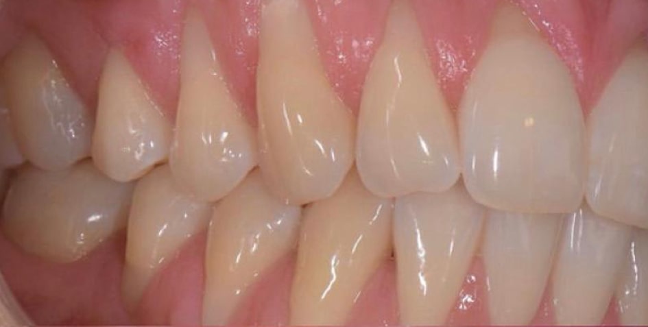 Rhone Dental Clinic Article Pulpite Image01