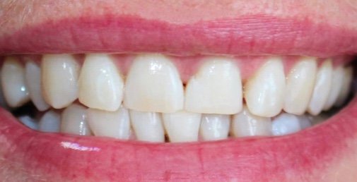 Rhone Dental Clinic Blanchiment Dentaire Apres