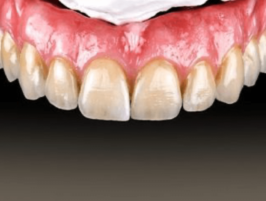 Rhone Dental Clinic Couronnes Dentaires Bridge Complet Ceramique