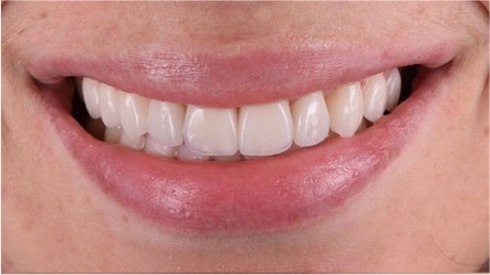 Rhone Dental Clinic Facettes Dentaires