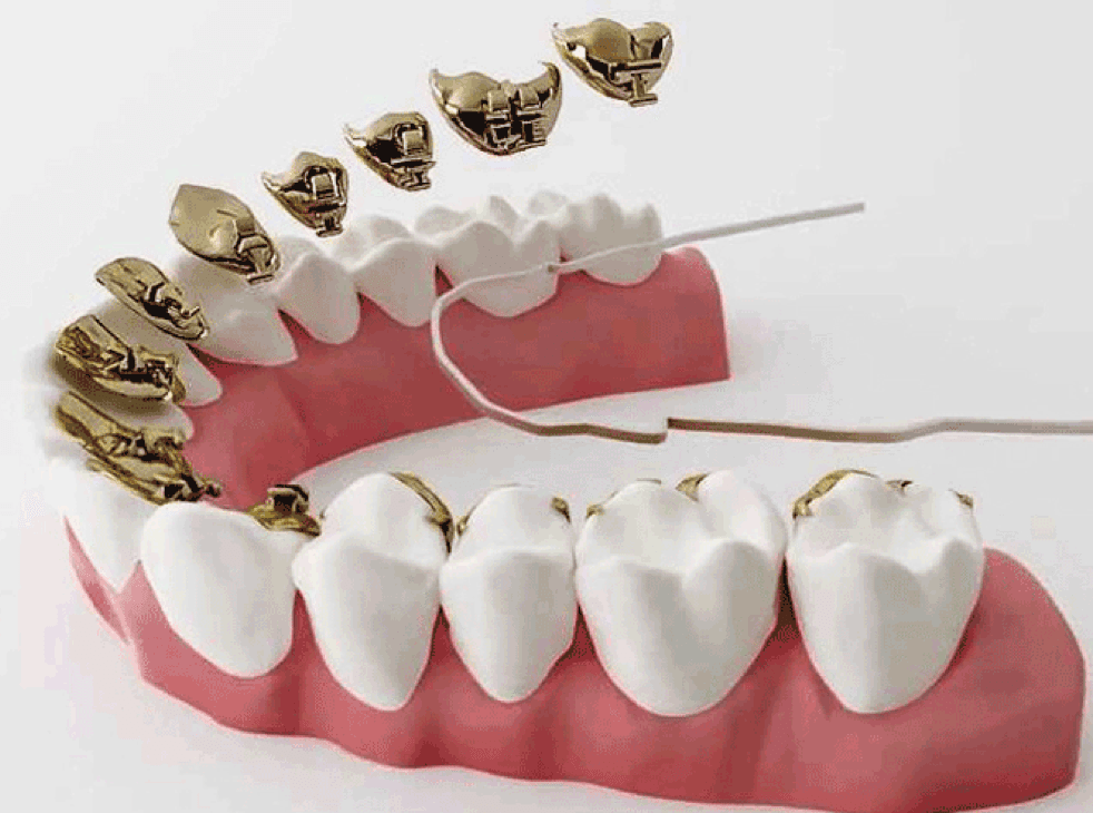 Rhone Dental Clinic Orthodontiste Orthodontie Linguale