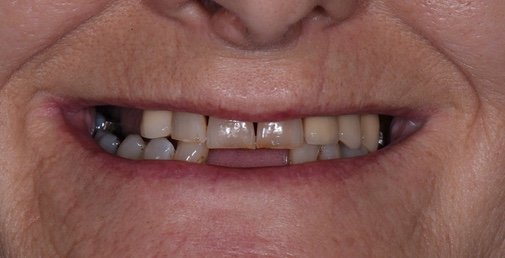 Rhone Dental Clinic Protheses Dentaires Avant