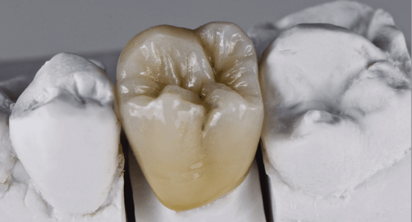 Rhone Dental Clinic Protheses Dentaires Couronne Unitaire Toute Ceramique 01