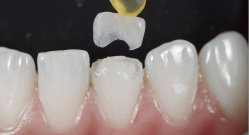 Rhone Dental Clinic Protheses Dentaires Reconstruction Par Chips Ceramique 01