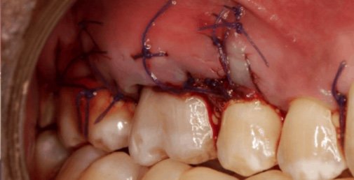 Rhone Dental Clinic Recessions Parodontales Apres