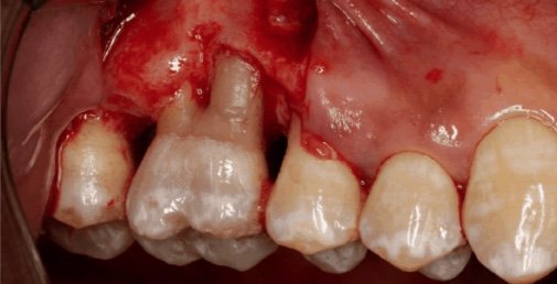 Rhone Dental Clinic Recessions Parodontales Avant