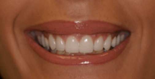 Rhone Dental Clinic Sourire Gingival 01 Apres