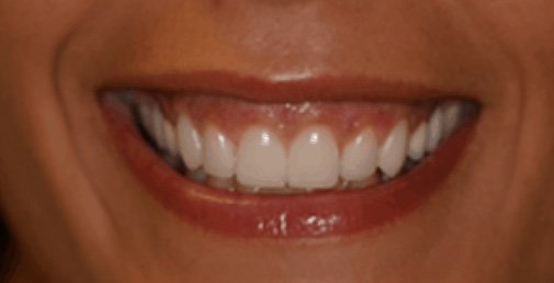 Rhone Dental Clinic Sourire Gingival 01 Avant