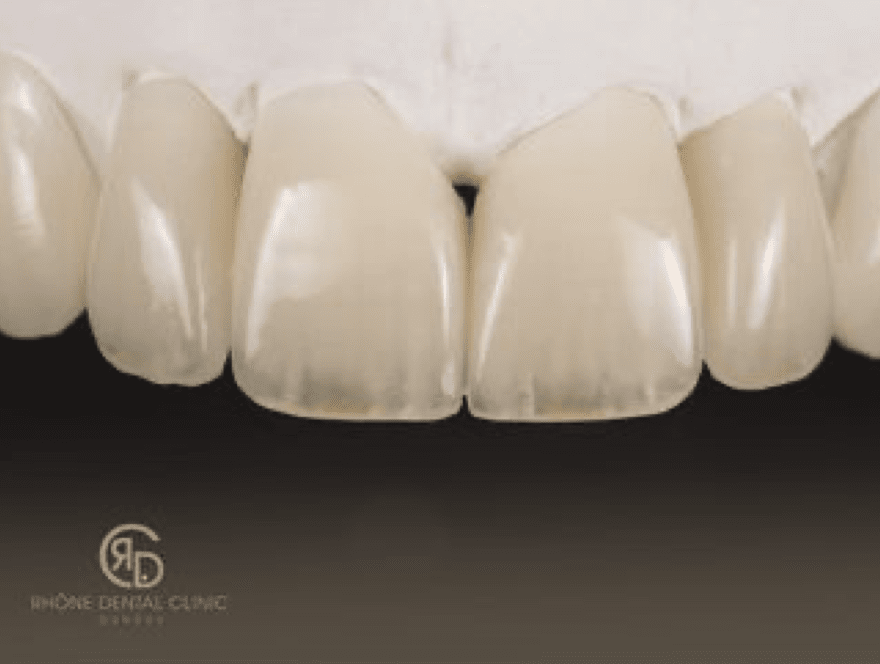 Rhone Dental Clinic Dental Crowns