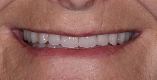 Rhone Dental Clinic Dental Dental Dentures