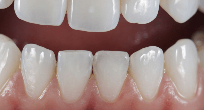 Rhone Dental Clinic Dental Dentures Reconstruction By Chips Ceramic 02