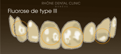 Rhone Dental Clinic Dental Facets Type 3b