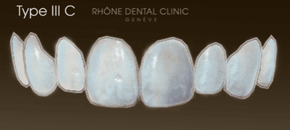 Rhone Dental Clinic Dental Facets Type 3c