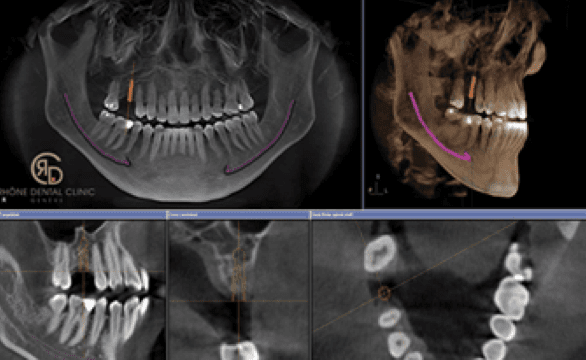 Rhone Dental Clinic Dental Implants Protocol Step 01 Diagnosis