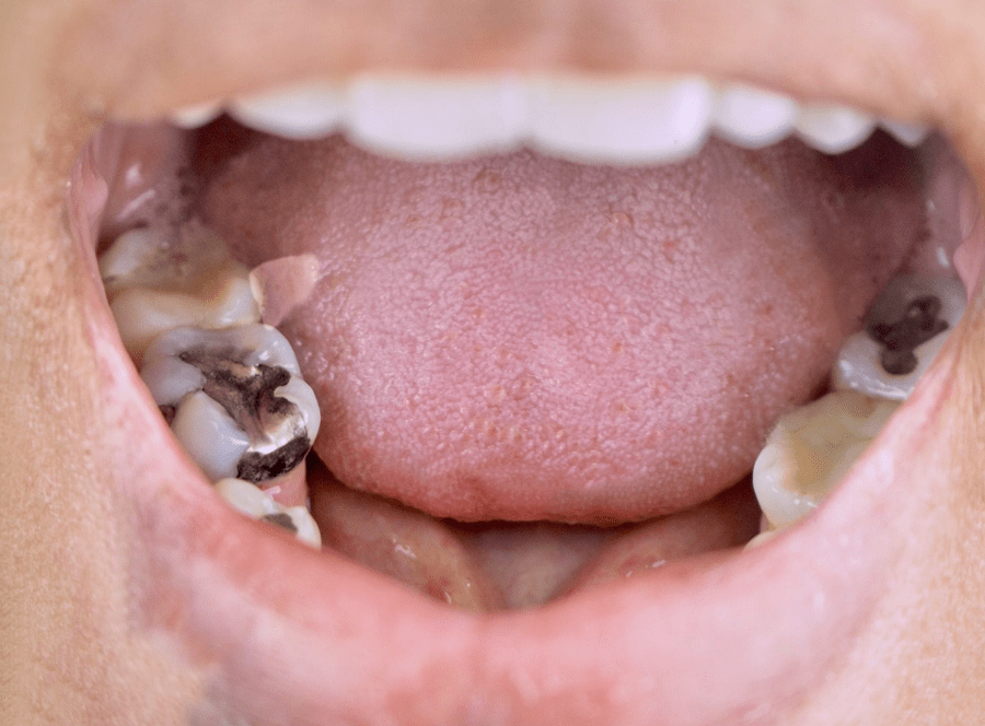 Rhone Dental Clinic Depose Amalgam Mercury