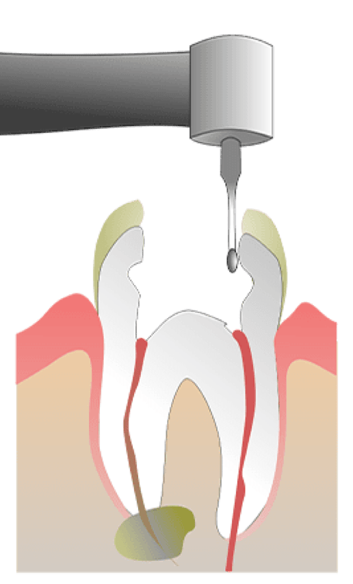 Rhone Dental Clinic Endodontics Stage Intervention 02 Tooth Opening