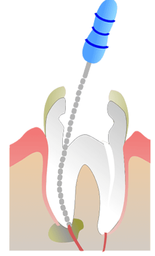 Rhone Dental Clinic Endodontics Stage Intervention 03 Tissue Removal Cleaning Canal Treatment Laser (1)