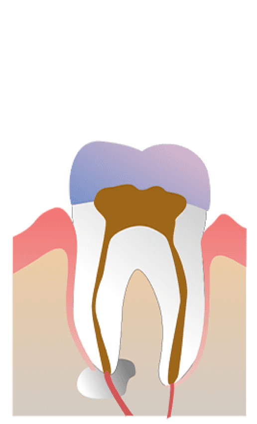 Rhone Dental Clinic Endodontics Stage Intervention 04 Opening Cell Filling