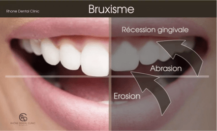 Rhone Dental Clinic Facets Dental Bruxism