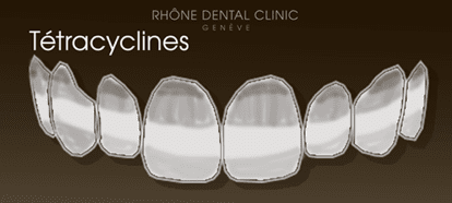 Rhone Dental Clinic Facets Dental Type 1a