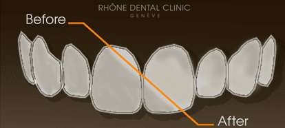 Rhone Dental Clinic Facets Dental Type 1b
