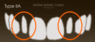 Rhone Dental Clinic Facets Dental Type 2a