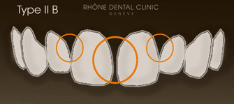 Rhone Dental Clinic Facets Dental Type 2b