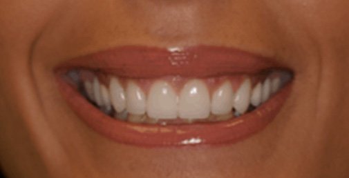 Rhone Dental Clinic Gingival Smile 01 After