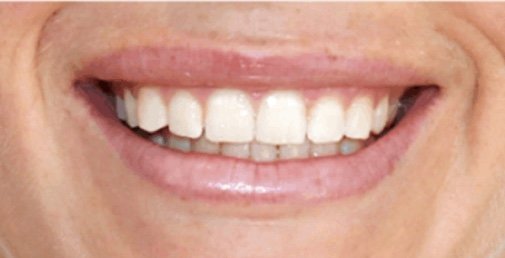 Rhone Dental Clinic Gingival Smile 02 After