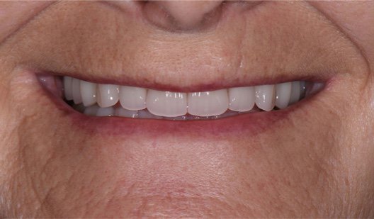 Rhone Dental Clinic Implants Dental