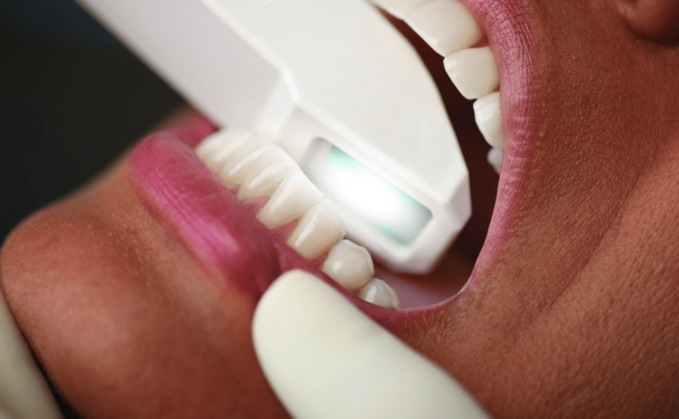 Rhone Dental Clinic Invisalign Clincheck Plus Predictible