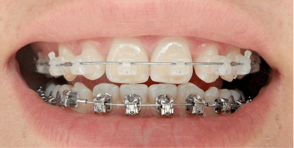 Rhone Dental Clinic Orthodontist Different Types Of Orthodontic Treatment