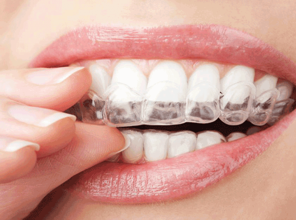 Rhone Dental Clinic Orthodontist Invisalign Orthodontics Invisible