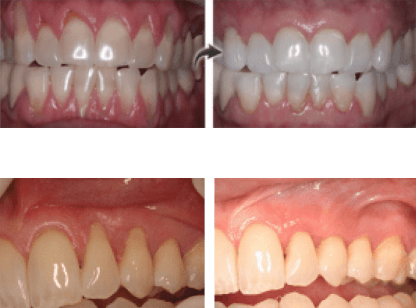 Rhone Dental Clinic Periodontal Recessions